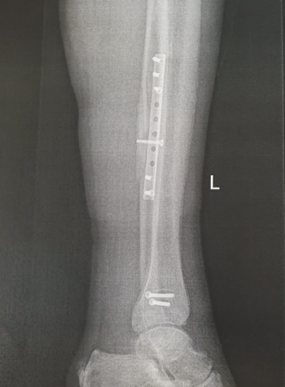 Ankle screws.png